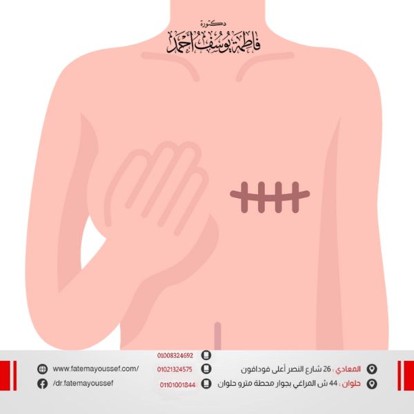 زراعة الثدي بعد استئصاله