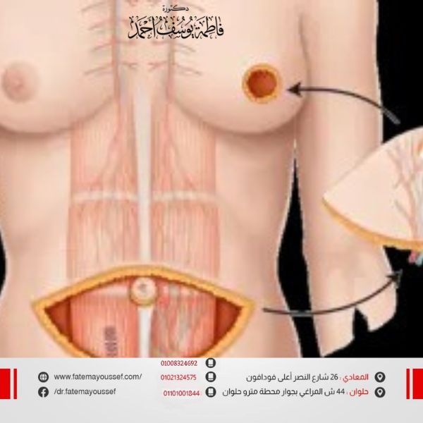 زراعة الثدي بعد استئصاله