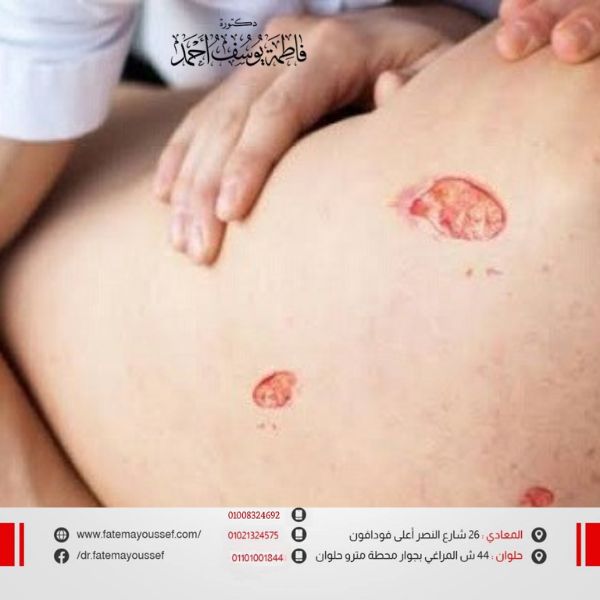 قرح الفراش وتسمم الدم