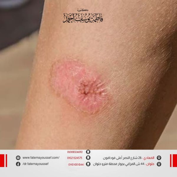 قرح الفراش وتسمم الدم