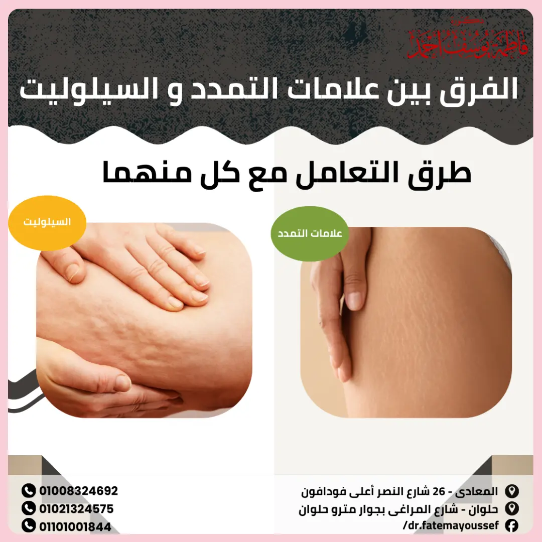الفرق بين علامات التمدد والسيلوليت