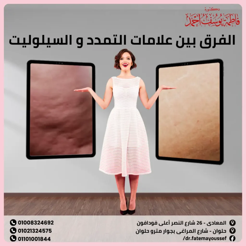 الفرق بين علامات التمدد والسيلوليت