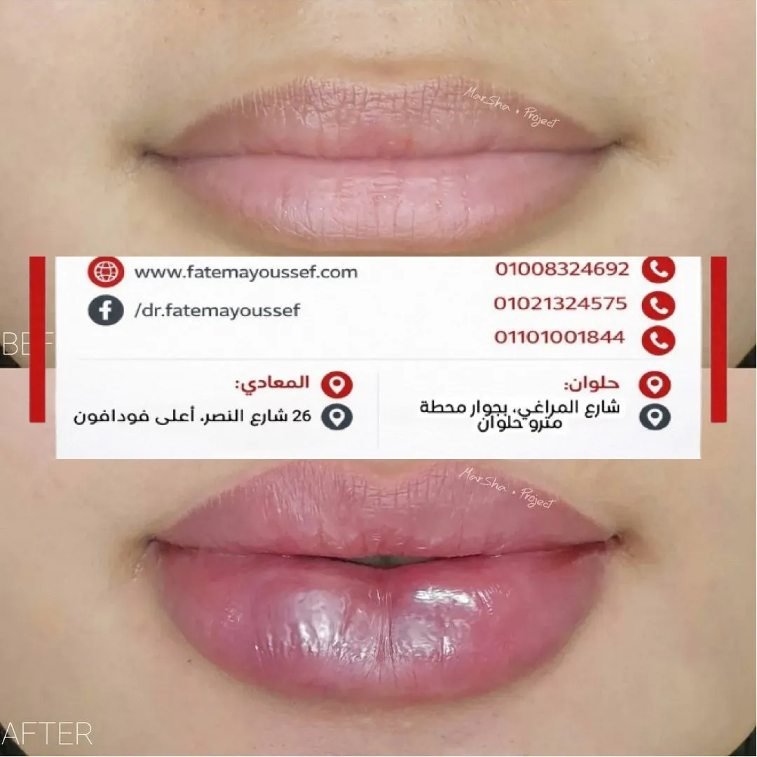 نفخ الشفايف بالفيلر قبل وبعد