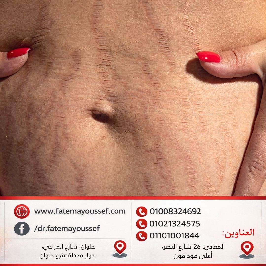 السترتش مارك الأحمر