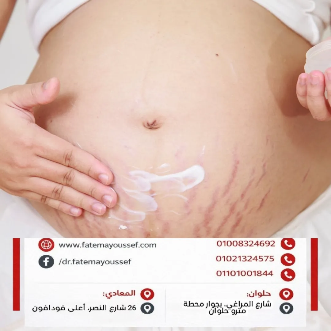 سترتش مارك البطن