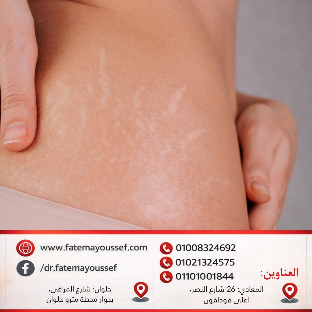 سبب ظهور علامات التمدد