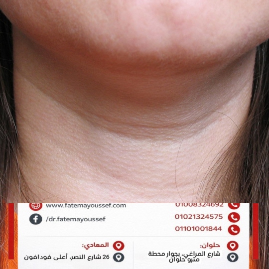 اسباب خطوط الرقبة