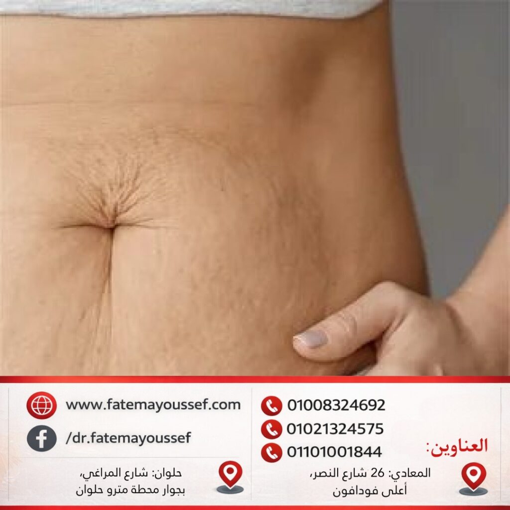 سبب ظهور علامات التمدد