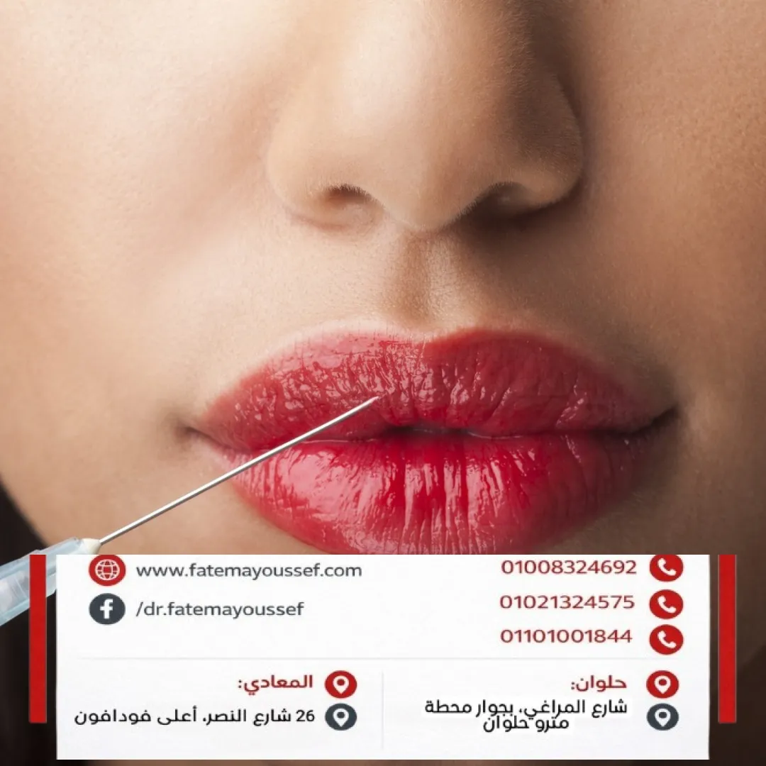 نفخ الشفايف بالفيلر قبل وبعد