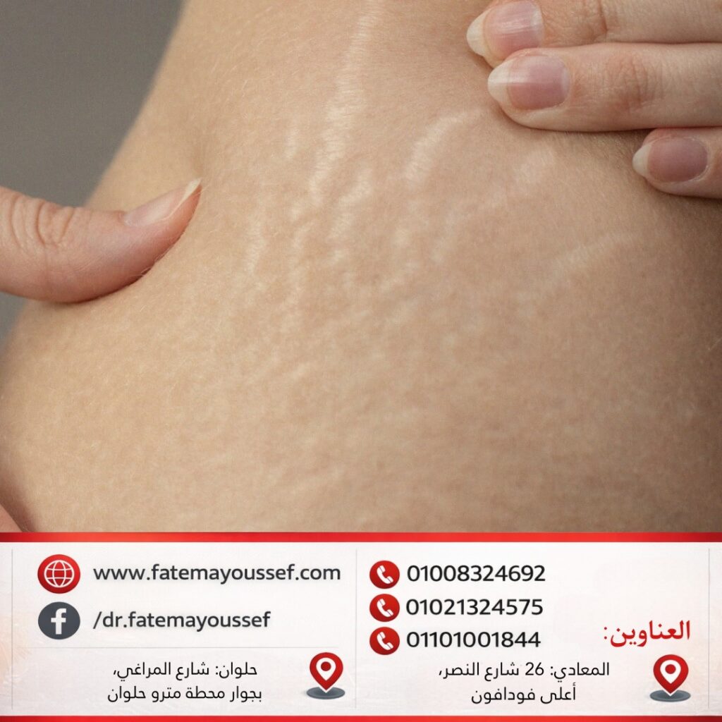 طرق علاج السترتش مارك البيضاء