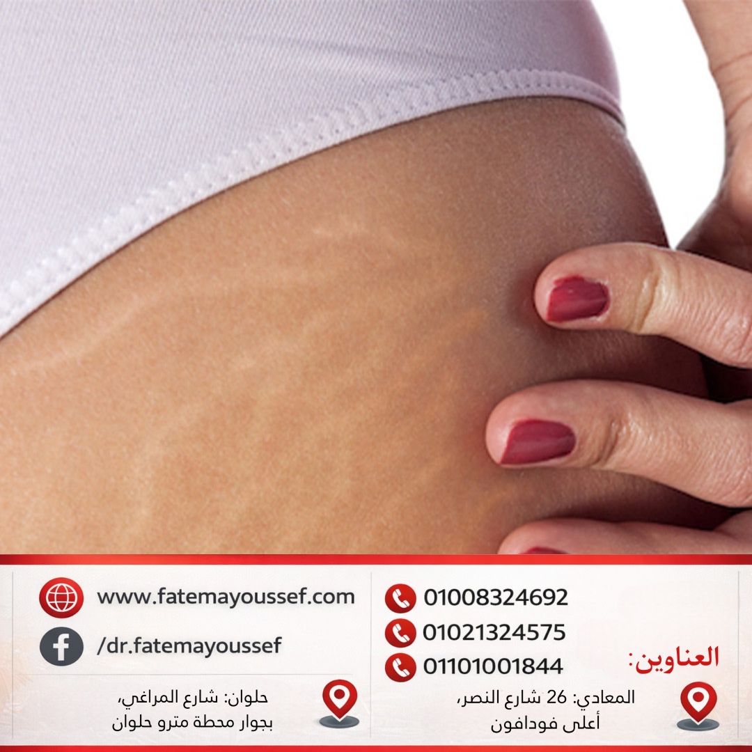 طرق علاج السترتش مارك البيضاء