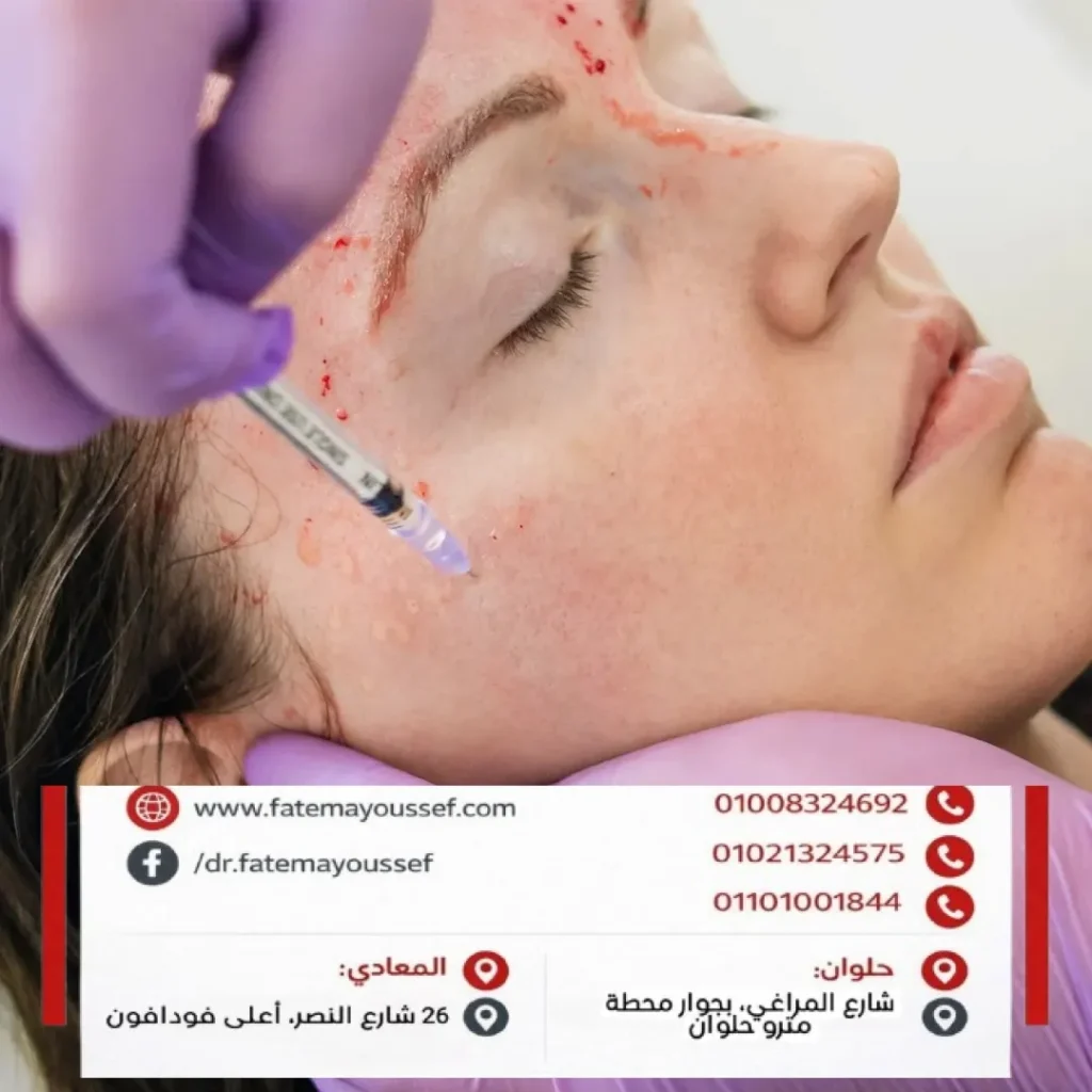 علاج تورم الوجه بعد حقن البلازما