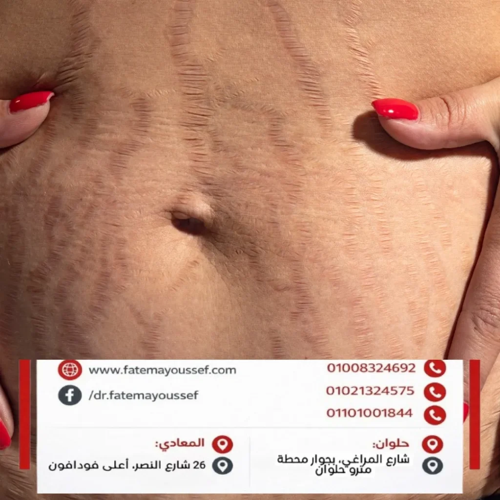 سترتش مارك البطن