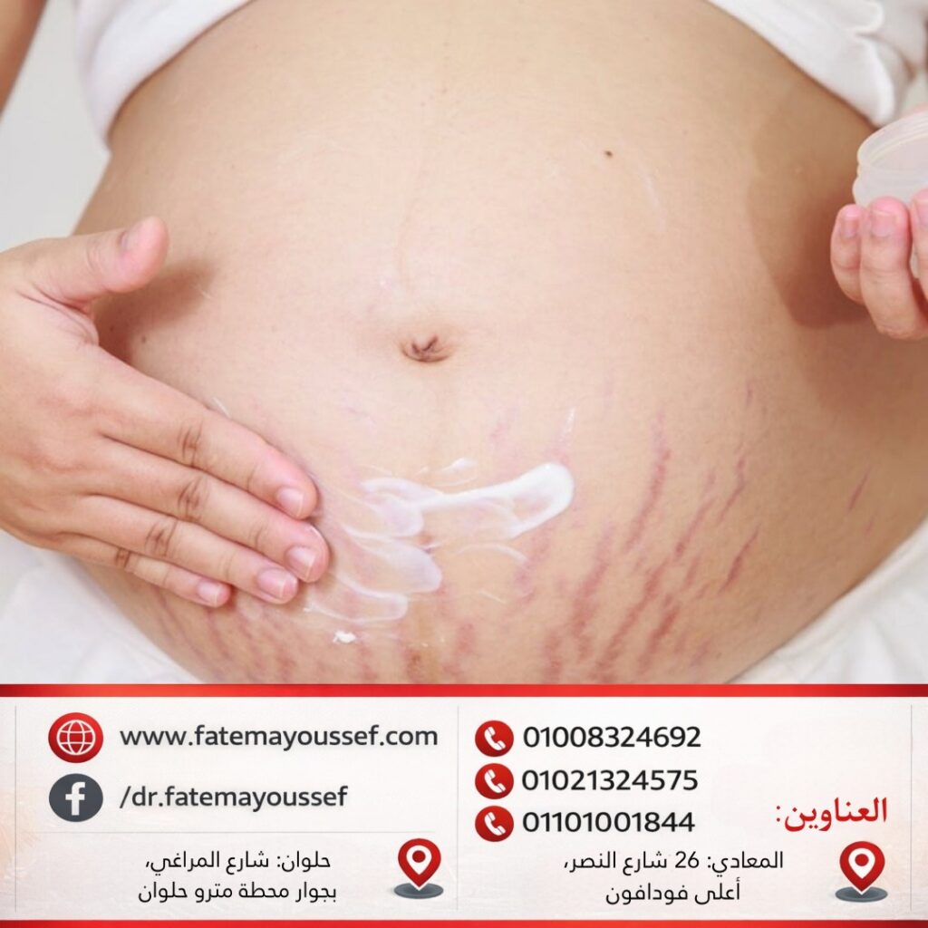 السترتش مارك الأحمر