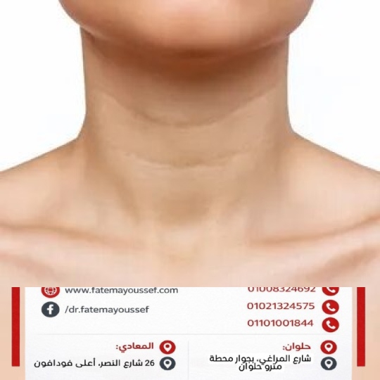 اسباب خطوط الرقبة