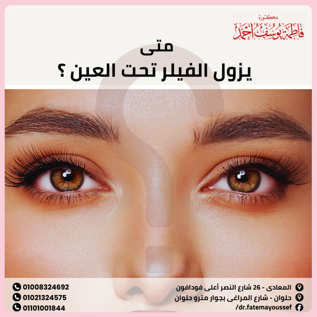 متى يزول الفيلر تحت العين