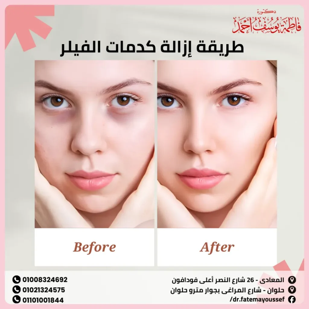 طريقة إزالة كدمات الفيلر