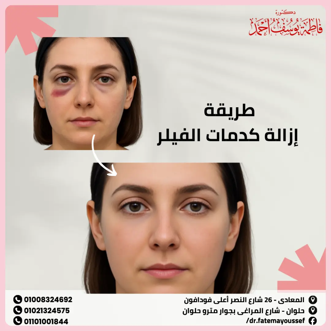 طريقة إزالة كدمات الفيلر