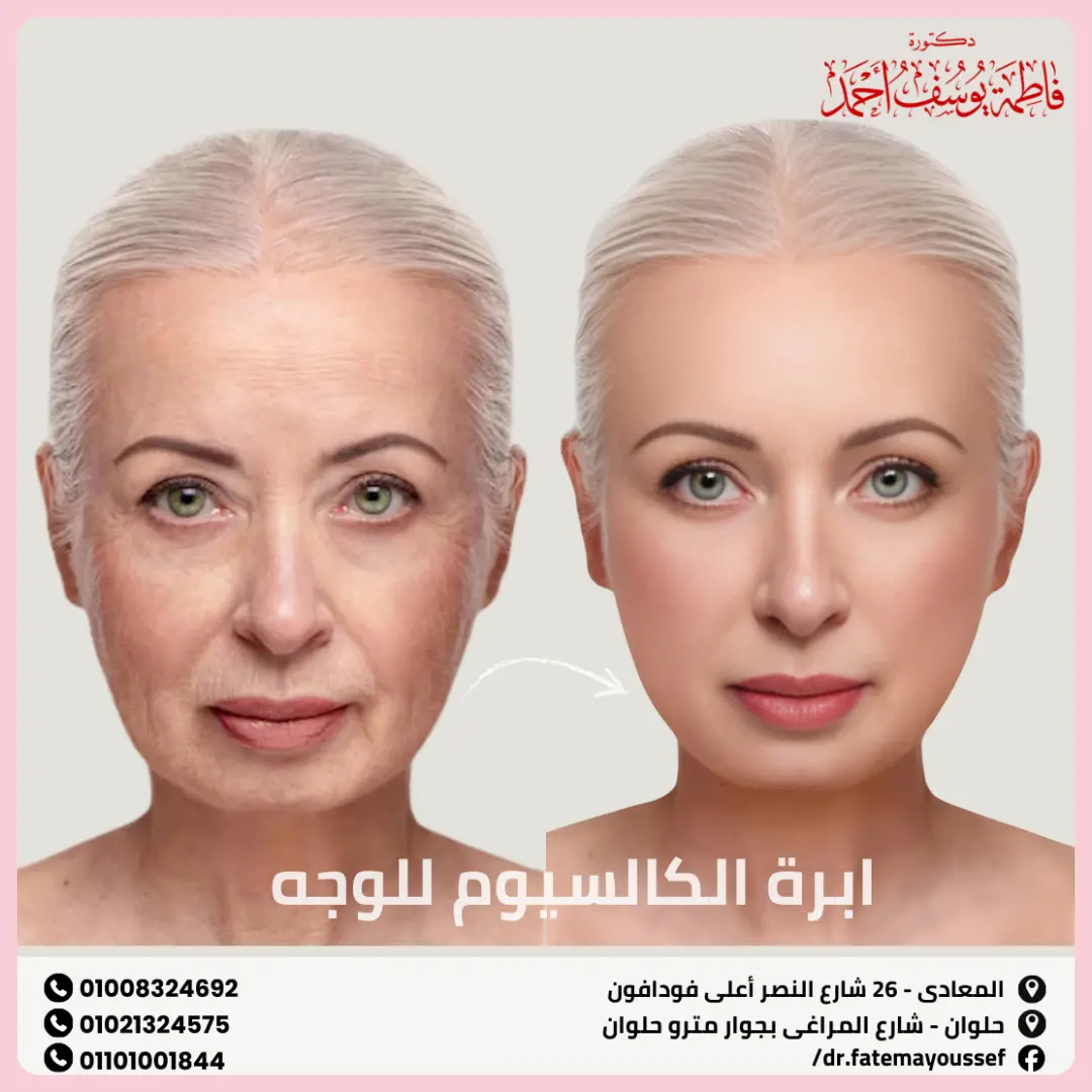 ابرة الكالسيوم للوجه قبل وبعد