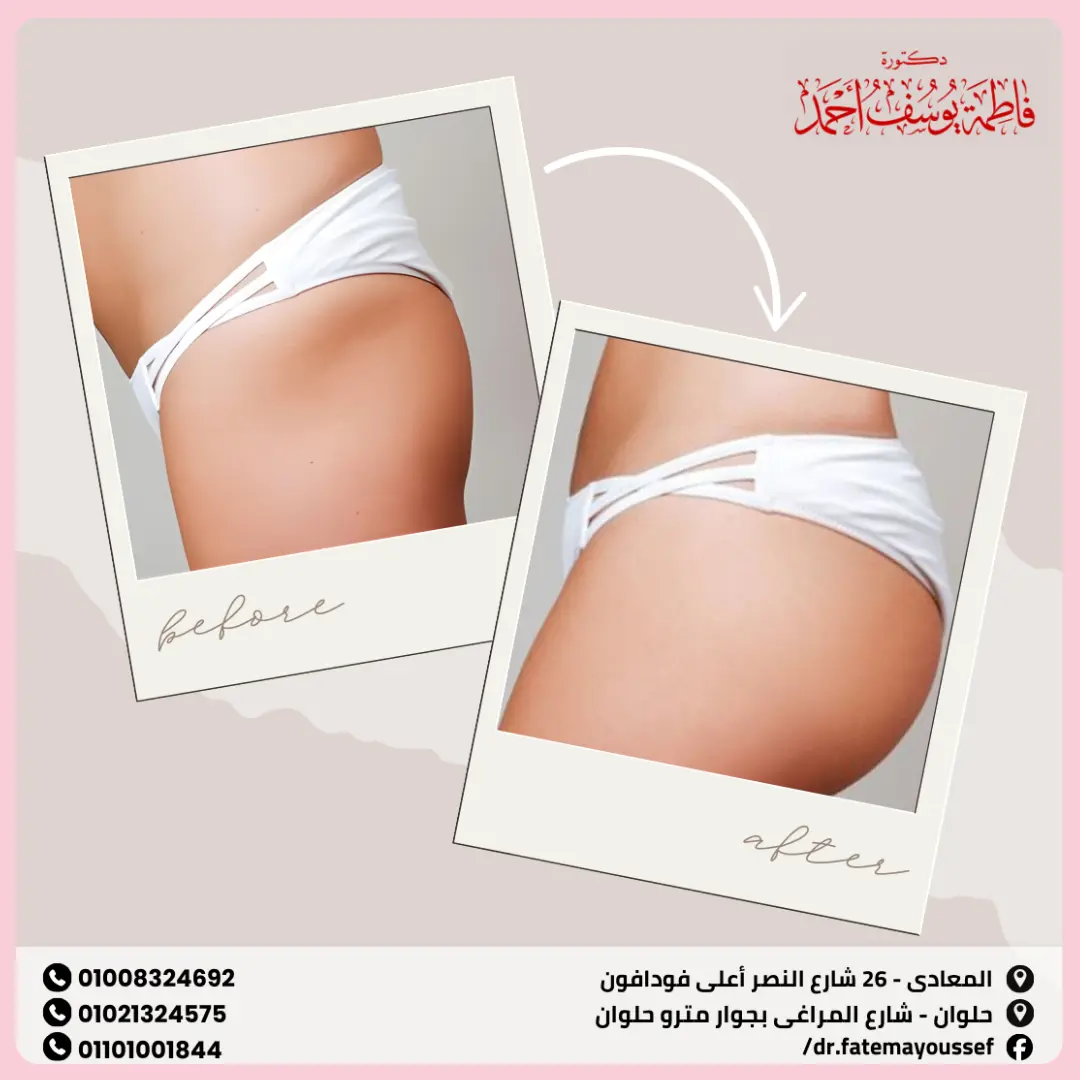 سعر عملية المؤخرة البرازيلية في مصر