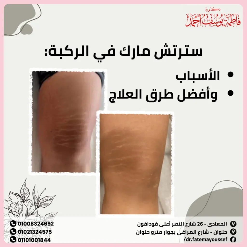 سترتش مارك في الركبة