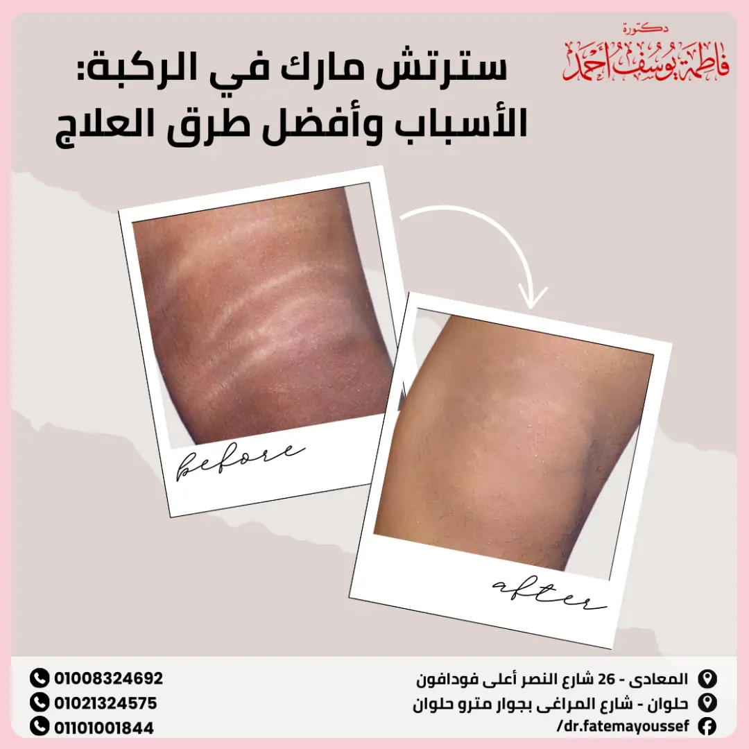 سترتش مارك في الركبة